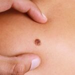 Metastatic Melanoma: Symptoms, Stages, Treatment